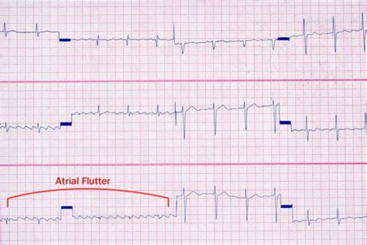 Are atrial runs dangerous?