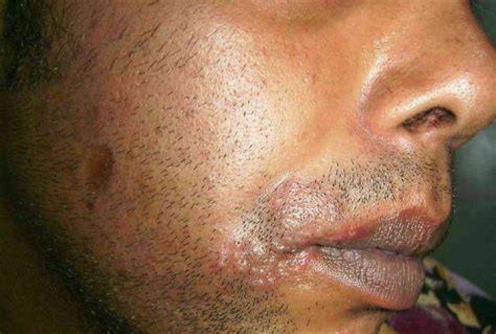 Are herpes outbreaks painful?