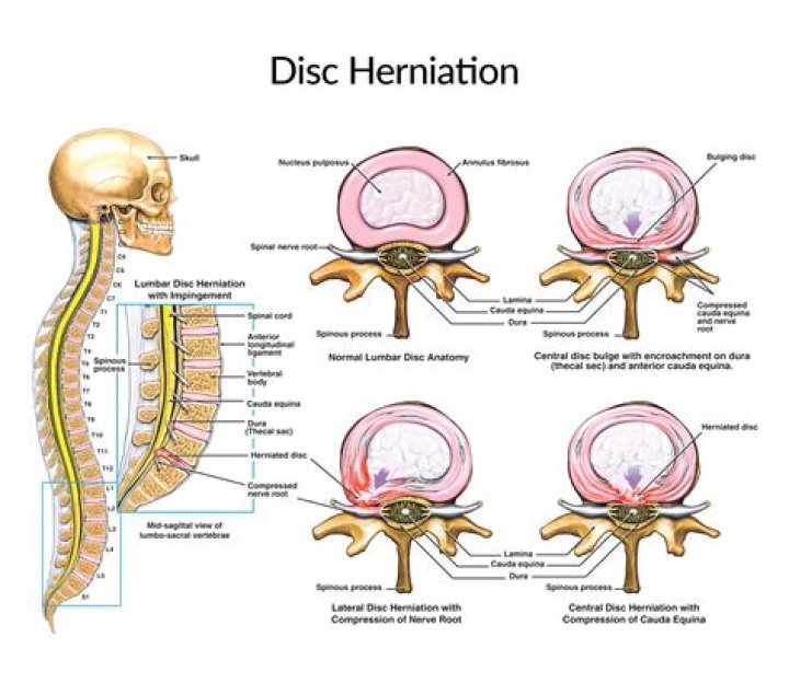 Are slipped disc and herniated disc the same?