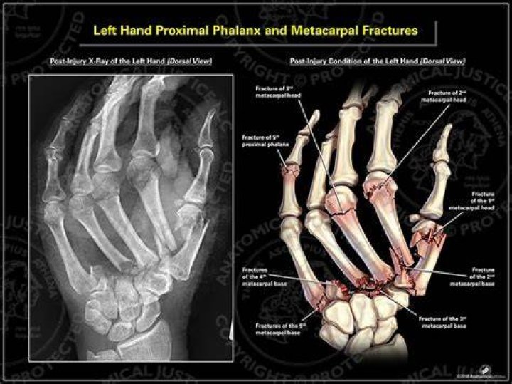 Can a broken metacarpal heal without a cast?