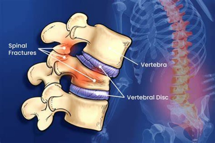Can a fractured vertebrae cause paralysis?