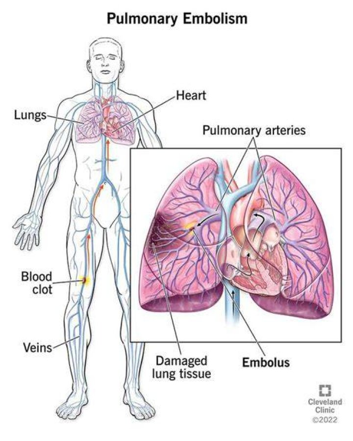Can embolism be cured?