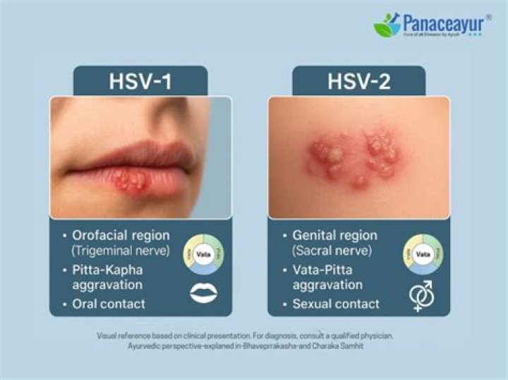 Can hvs1 turn into hvs2?