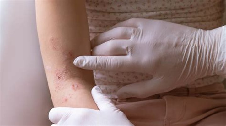 Can lurasidone cause rash?