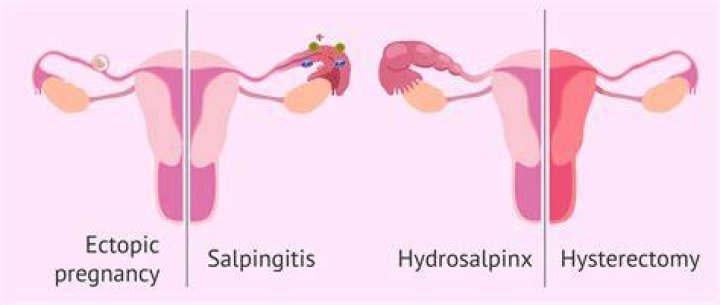 Can salpingectomy cause early menopause?