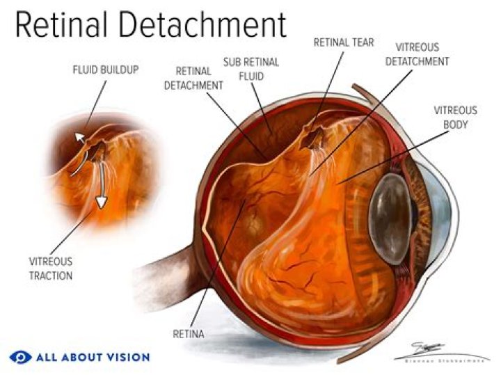 Can you fly with a detached retina?