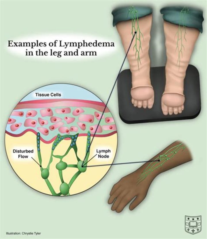 Can you get rid of lymphedema?