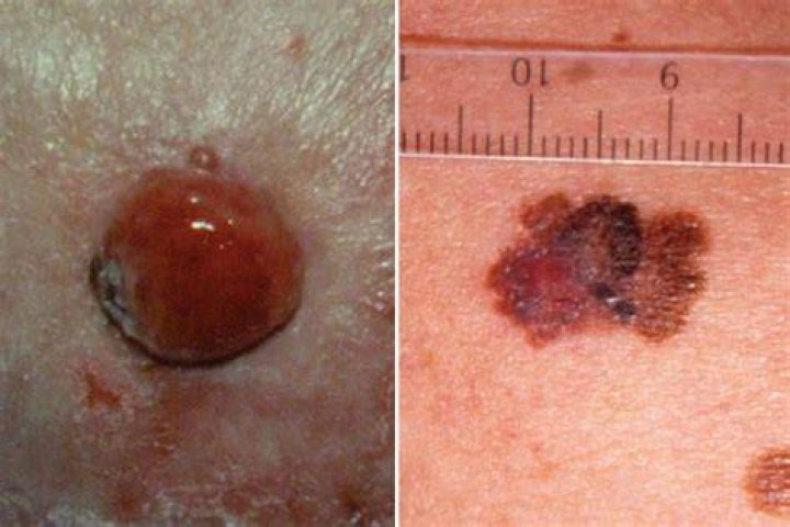 Can you scratch off nodular melanoma?