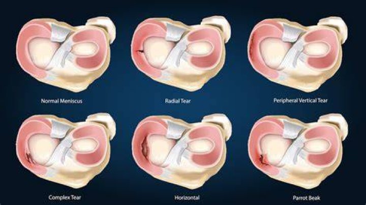 Could you walk with a torn meniscus?