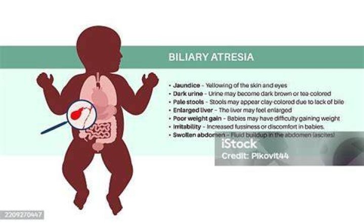Do babies with biliary atresia gain weight?
