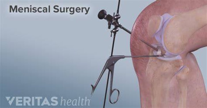 Do you need surgery for a torn meniscus?