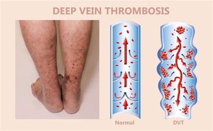Do you treat superficial venous thrombosis?