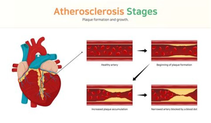 Does atherosclerosis cause arteriosclerosis?