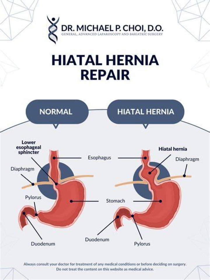 How long is hiatal hernia surgery?