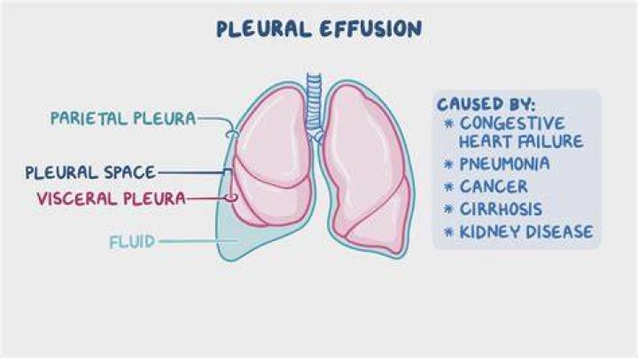 How pleural effusion occurs?
