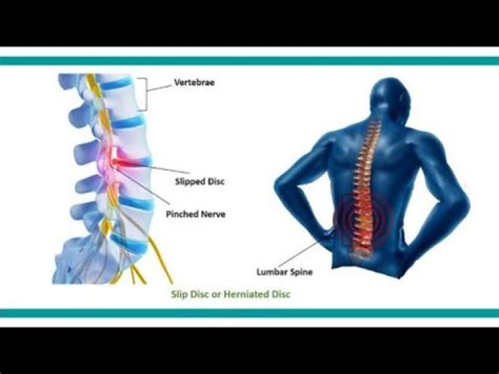 How to fix a slipped disc?