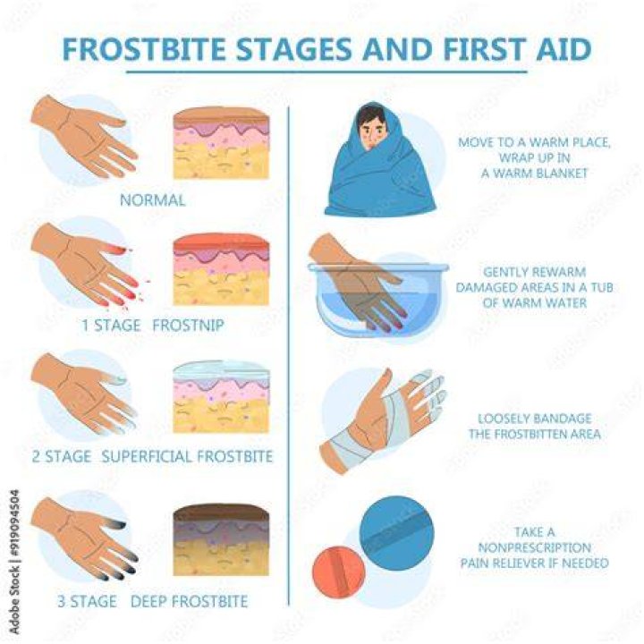 How to heal frostbite?
