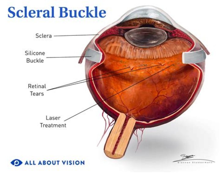 Is scleral buckle mri safe?
