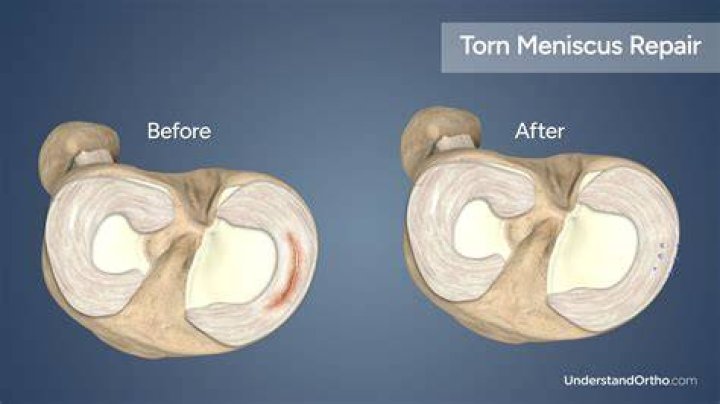 Should a meniscus tear be operated on?