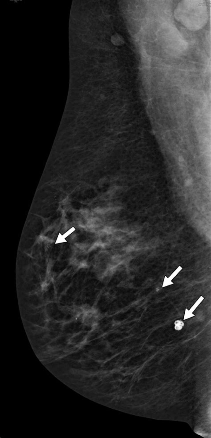 Should calcifications in breast be removed?