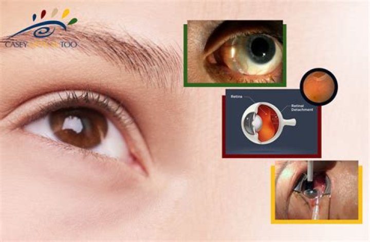 Should i go to the er for a detached retina?