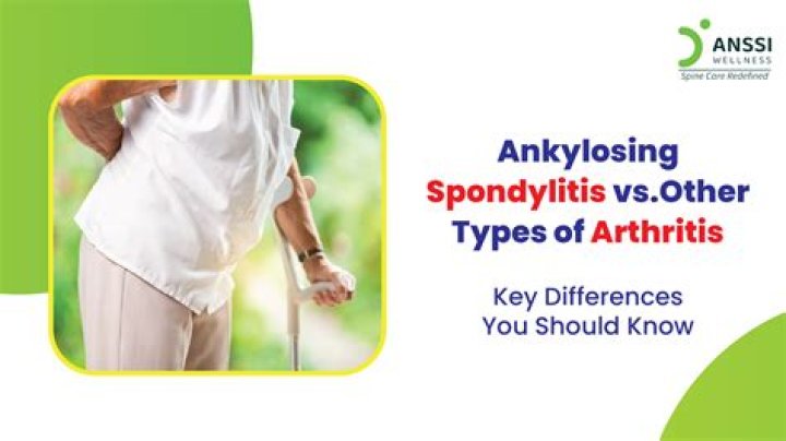 Should i run with ankylosing spondylitis?