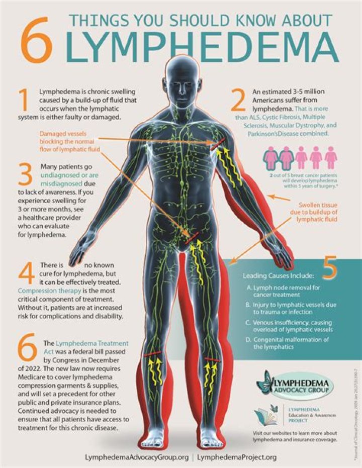Should you ice lymphedema?