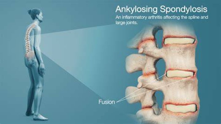Was ist ankylosing spondylitis?