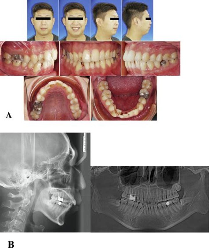 What are extraoral radiographs?