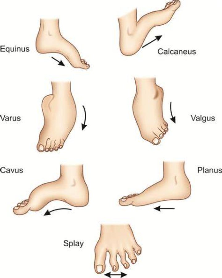 What are foot deformities?