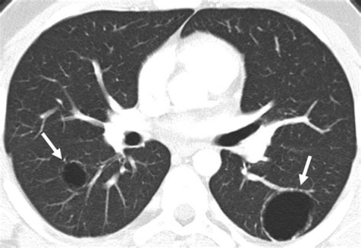 What does lobulated cyst mean?