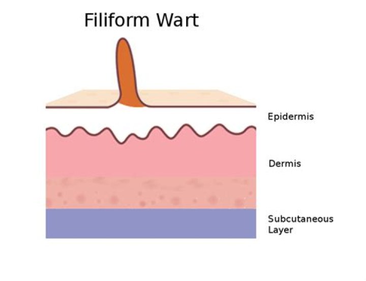 What is a filiform wart?
