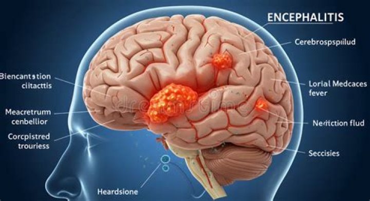 What is brain stem encephalitis?