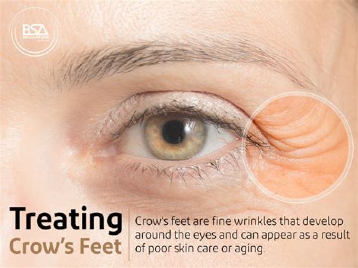 What is crow toe?