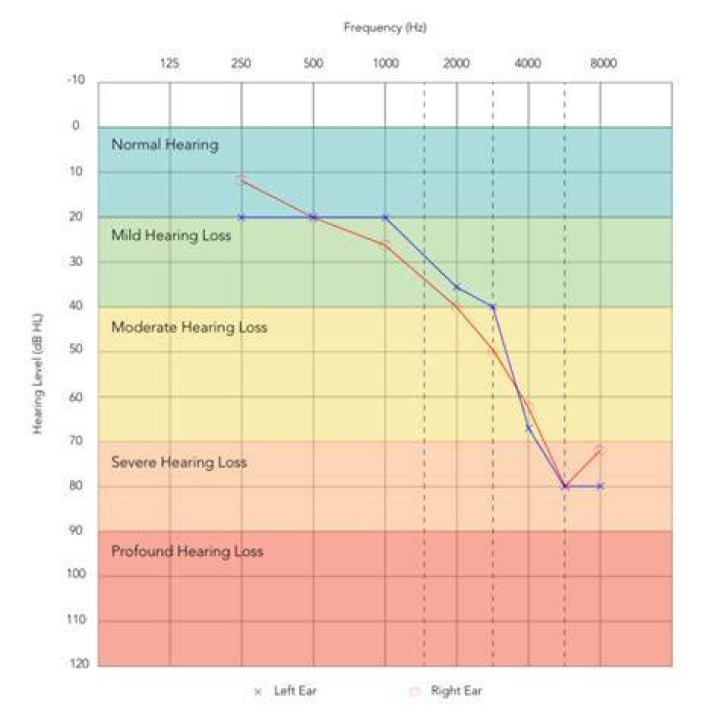 What is fluctuating hearing loss?