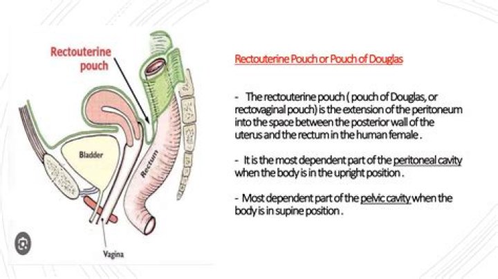 What is recto uterine pouch?