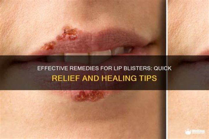 What to put on blistered lips?