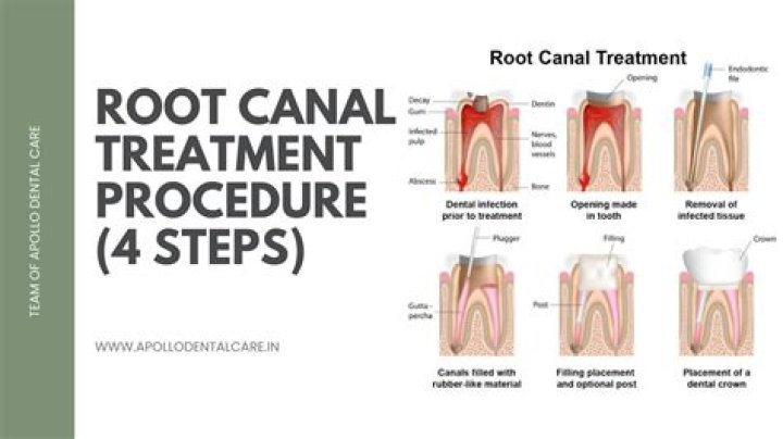 When is rct done?