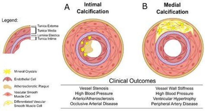 Where can calcification be found?