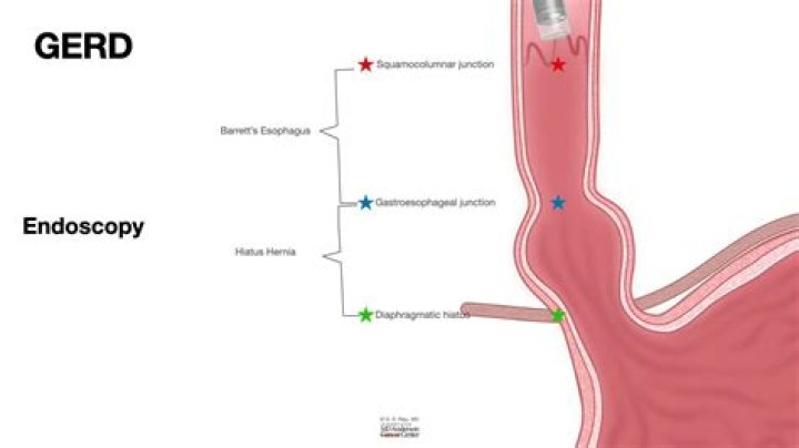 Where is the squamocolumnar junction located?