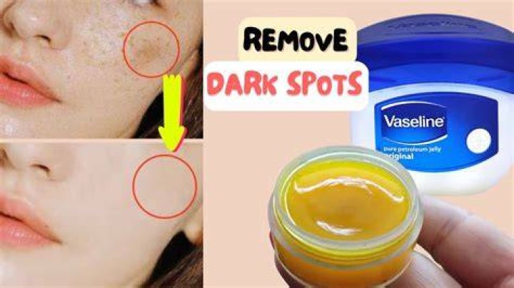 Which cream remove dark spot on face?