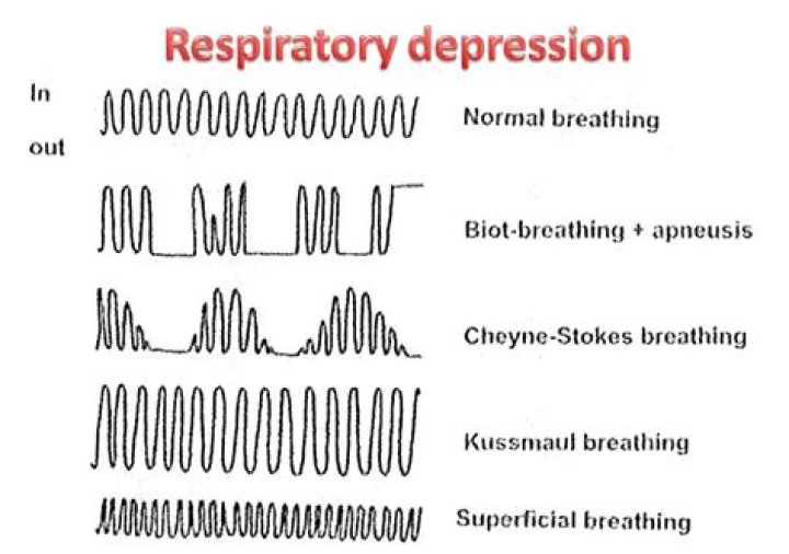 Which is a description of cheyne-stokes respirations quizlet?