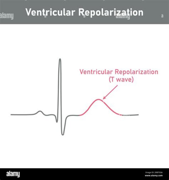 Which wave on the ecg represents ventricular repolarization?