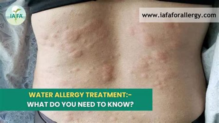 Who's allergic to water?