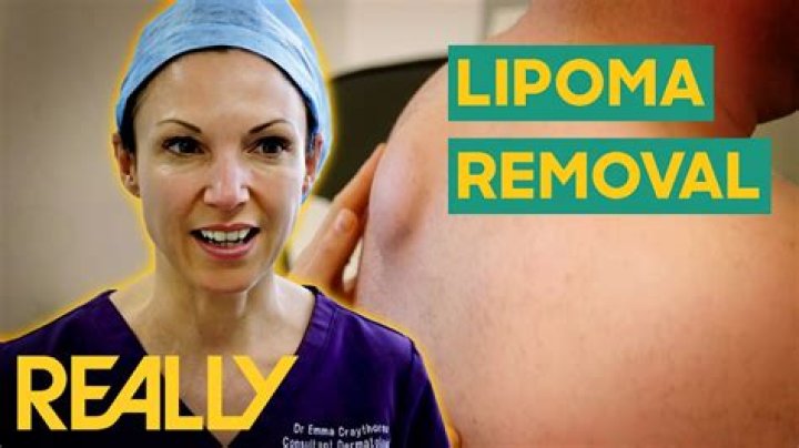 Who removes large lipomas?