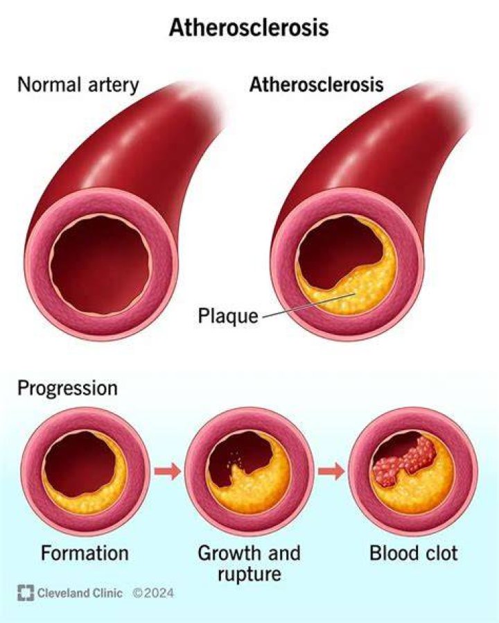 Why does atherosclerosis increase blood pressure?