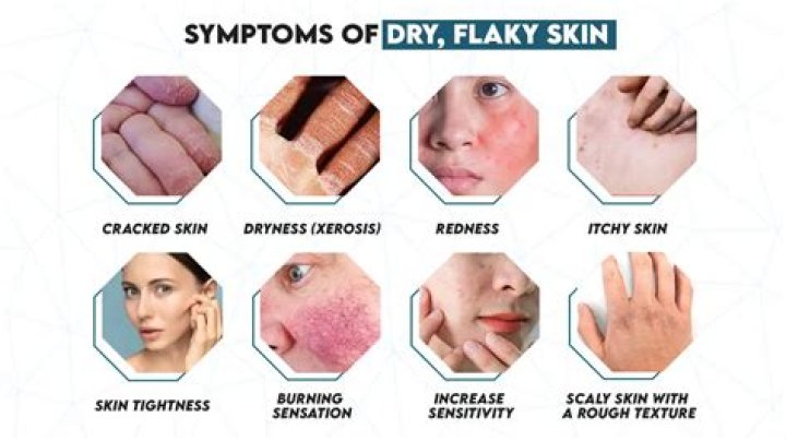Why does my skin feel papery?