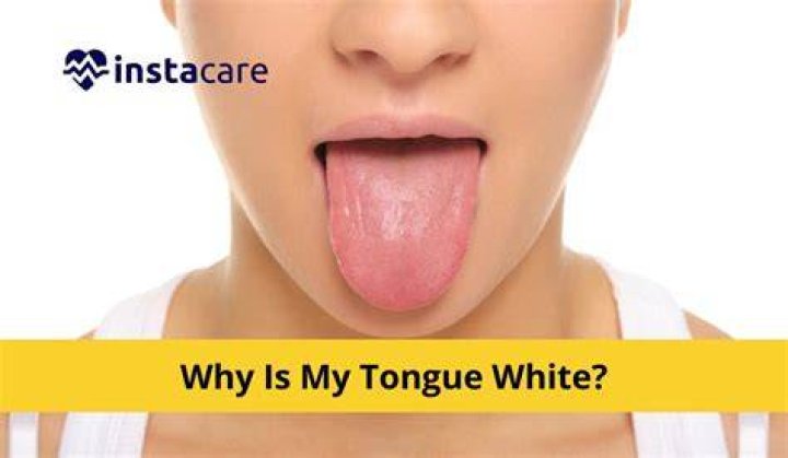 Why my tongue is white?