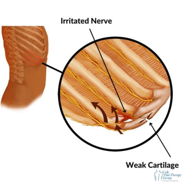 Will a slipped rib fix itself?