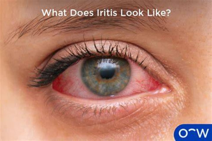 Will iritis go away?
